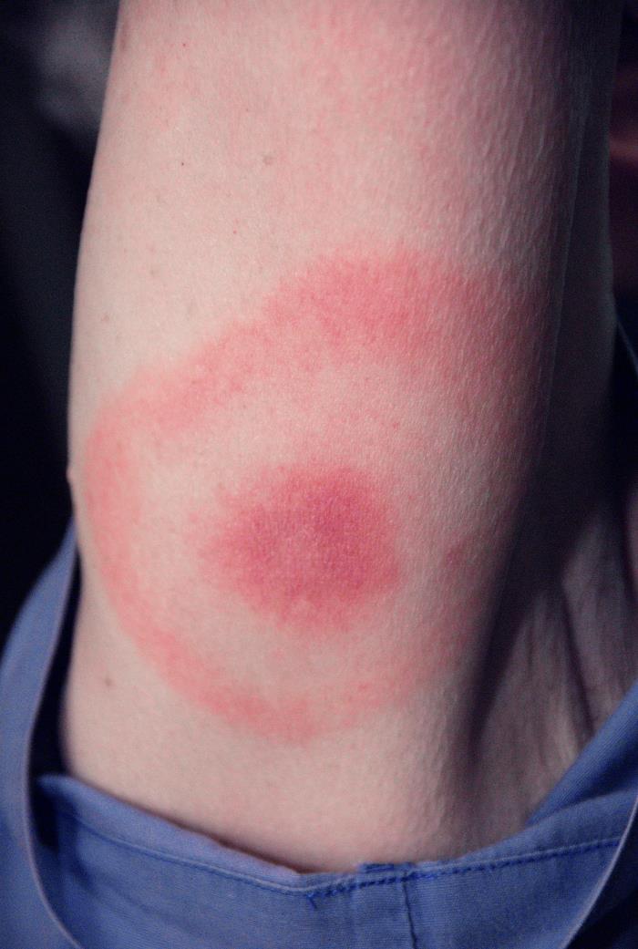 What Ticks Carry, How to Spot It and Whether It Can Be Cured